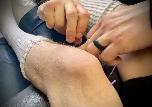 Un profesional coloca una aguja de punción seca cerca de la rodilla de un paciente.
